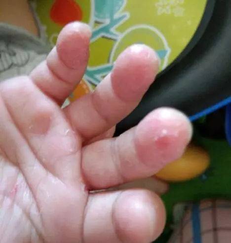 小孩手指脫皮不單是缺維生素，還有哪些原因？家長(zhǎng)別忽略了