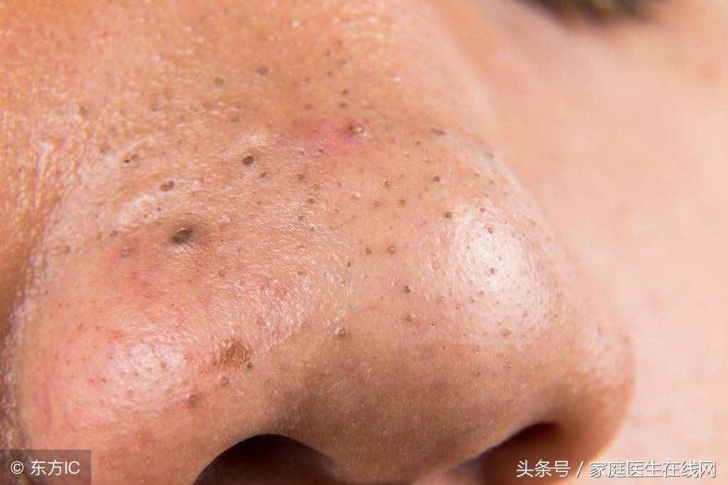 臉上黑頭太多怎么辦？這3個正確方法幫助你消滅它們