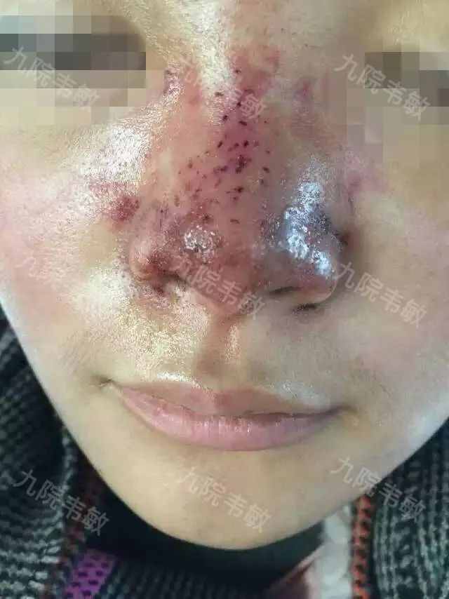 鼻整形為什么不建議注射隆鼻？