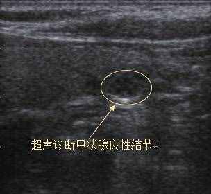 七個(gè)問(wèn)答，全面了解甲狀腺結(jié)節(jié)