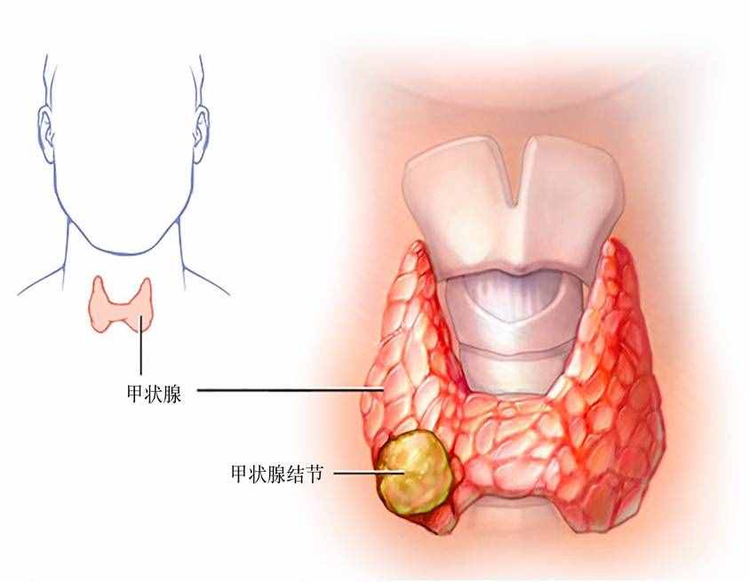 七個(gè)問(wèn)答，全面了解甲狀腺結(jié)節(jié)