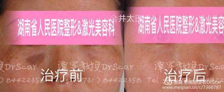 褐青色痣（顴骨母斑）的激光治療