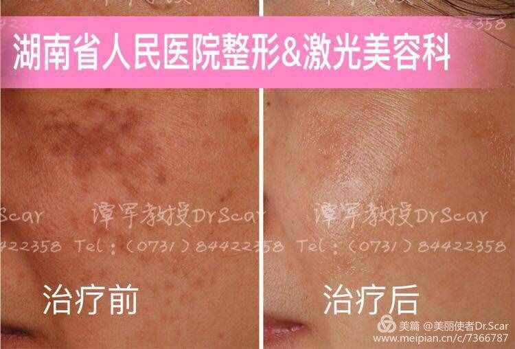 褐青色痣（顴骨母斑）的激光治療