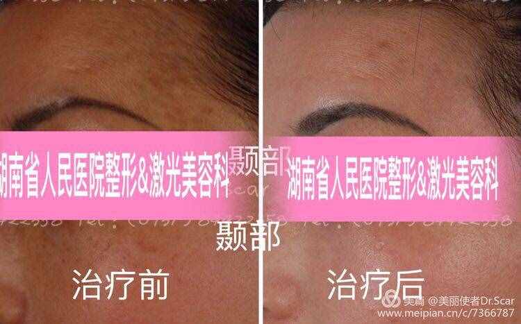 褐青色痣（顴骨母斑）的激光治療
