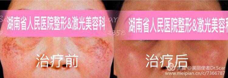 褐青色痣（顴骨母斑）的激光治療