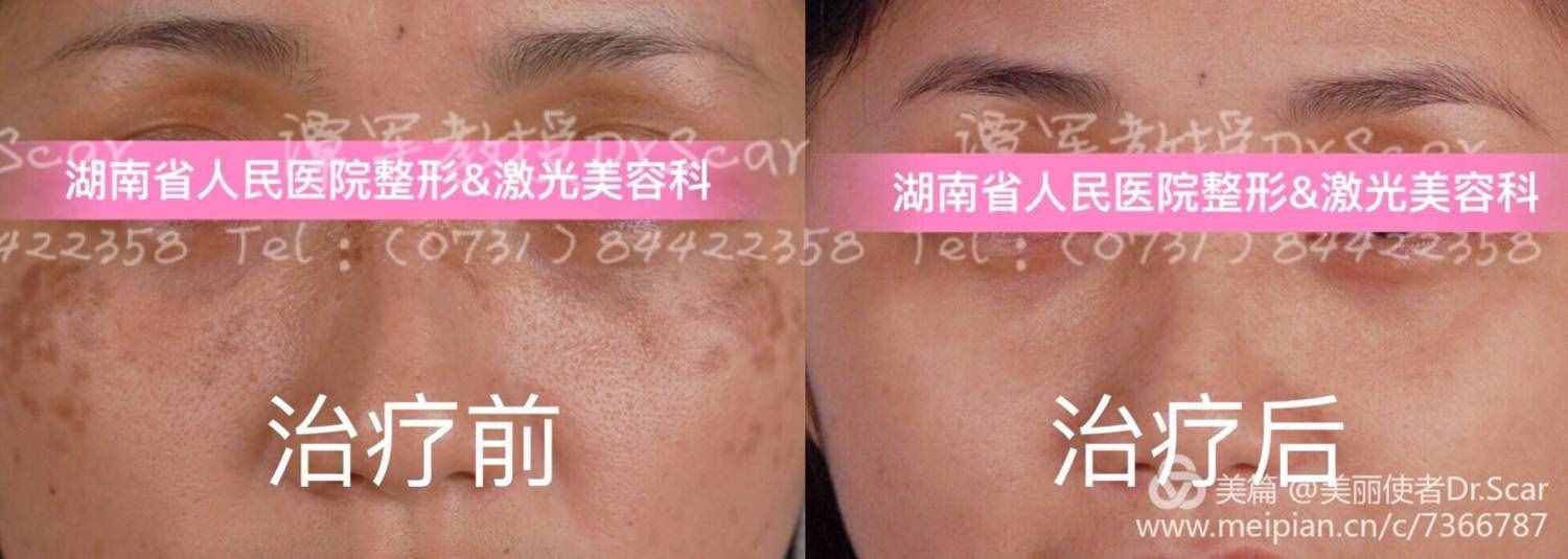 褐青色痣（顴骨母斑）的激光治療