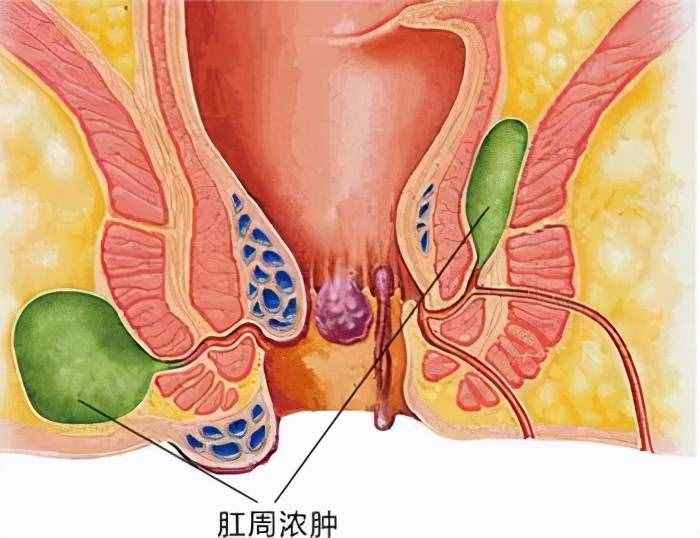 您是否還在等待肛裂自愈