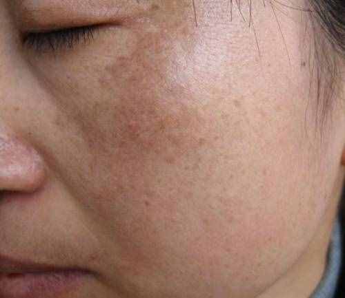 臉上有很多斑怎么淡斑？四種小妙招