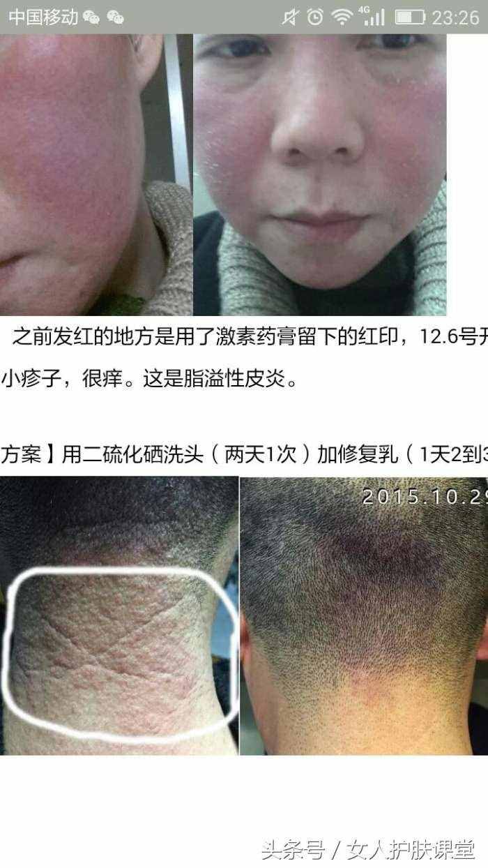 脂溢性皮炎怎么治療？