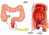 今日更新輕微痔瘡圖片（什么是痔瘡）