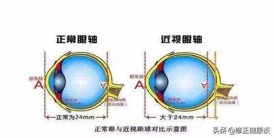 近視的人，經(jīng)常戴眼鏡讓眼睛變形了，怎么辦