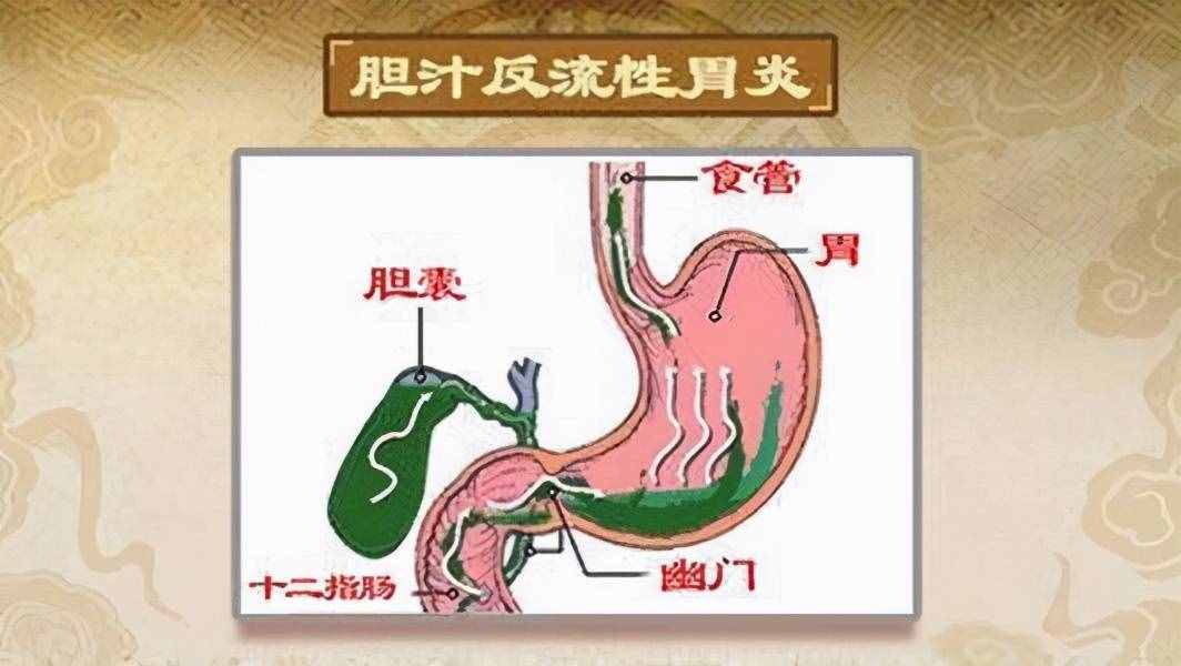 膽汁反流性胃炎怎么治療？醫(yī)生推薦4種常用的治療藥物