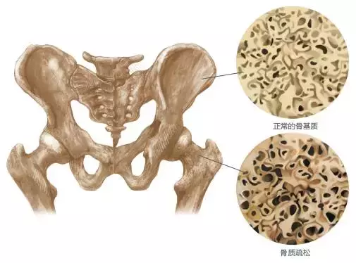 微創(chuàng)“骨水泥手術”——老年人的福音