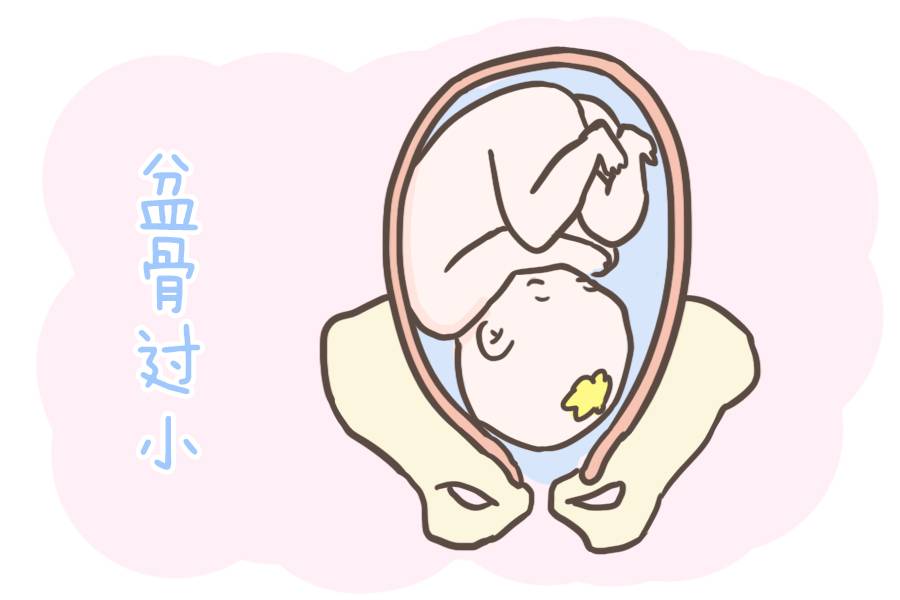 準(zhǔn)媽媽第一胎如果是剖腹產(chǎn)，那么第二胎該怎么生？看完這篇就懂了