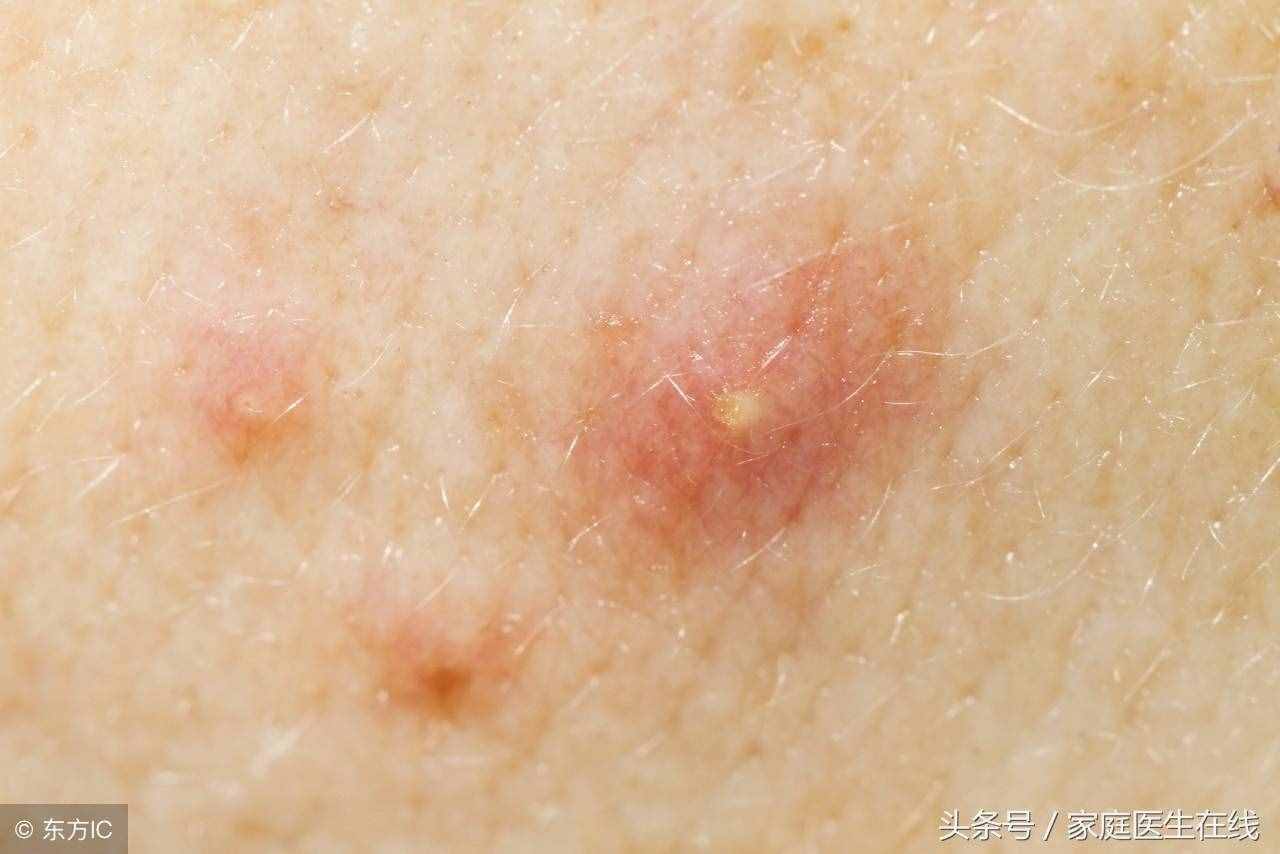 鼻子兩側(cè)老是喜歡長痘痘，或是這四個(gè)原因作怪
