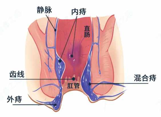 痔瘡久治不愈？是你沒用對藥，肛腸科醫(yī)生列出「詳細用藥攻略」