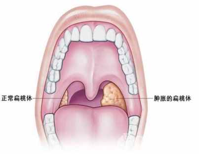 孩子扁桃體發(fā)炎怎么辦？到底要不要切？