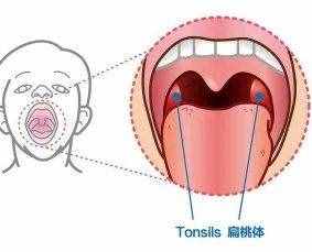 孩子扁桃體發(fā)炎怎么辦？到底要不要切？