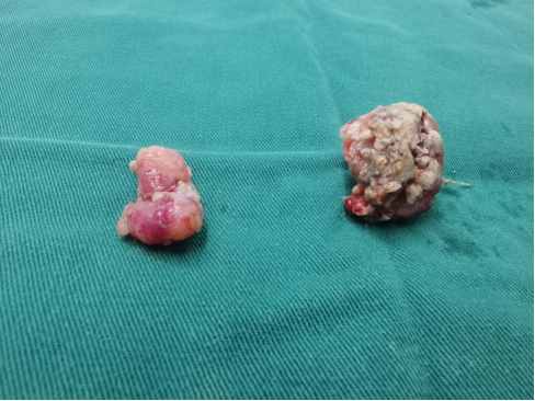 孩子扁桃體發(fā)炎怎么辦？到底要不要切？