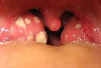 孩子扁桃體發(fā)炎怎么辦？到底要不要切？