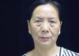 今日更新怎么樣去眼袋效果好（最顯老的不是皺紋）