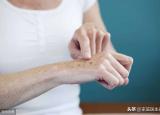 今日更新老年斑是怎么形成（老年斑）