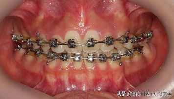 齙牙的矯正方法有哪些？
