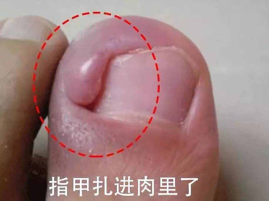 為啥腳趾甲動不動就長到肉里，還疼得受不了？在家怎么解決？