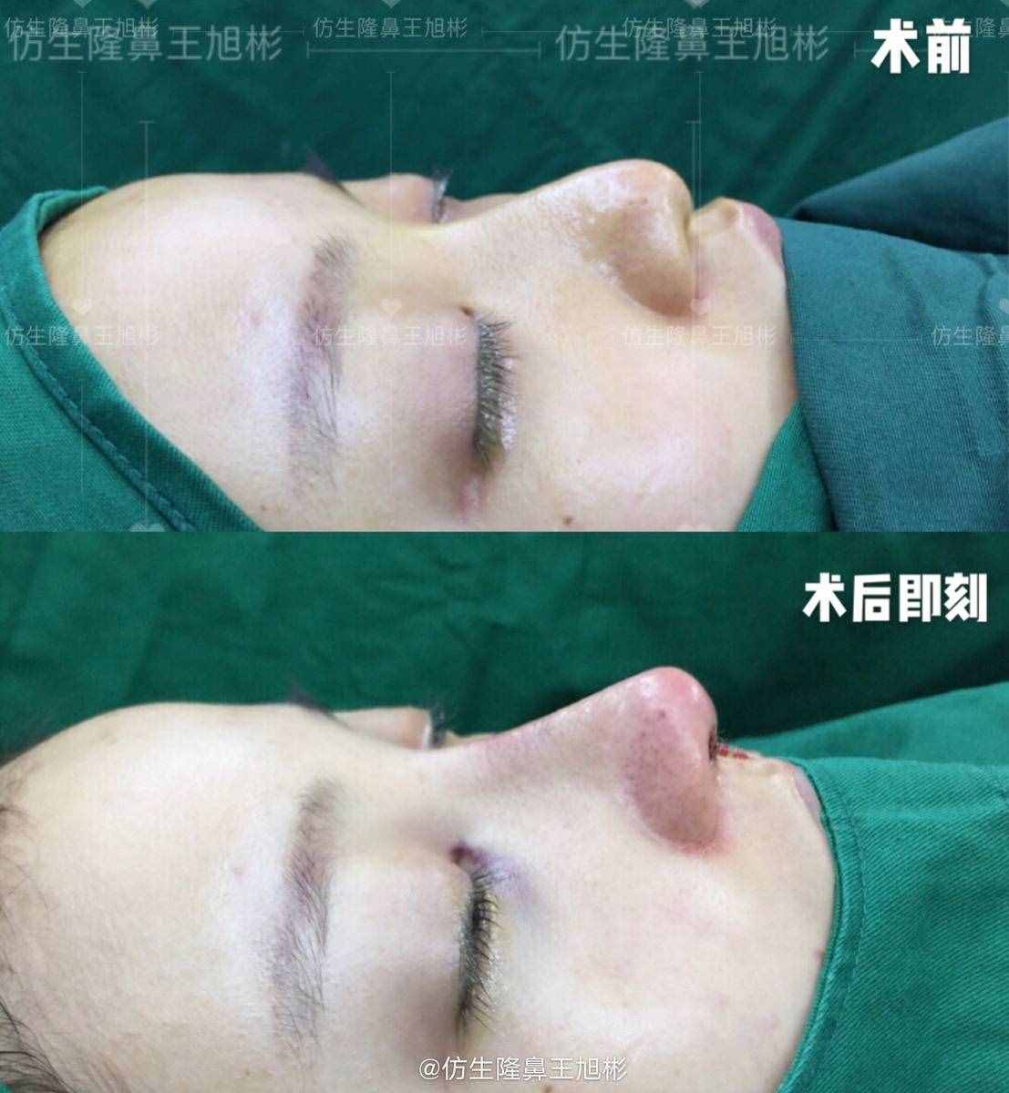 鼻頭肥塌大，如何逆襲成自然小秀挺？王旭彬仿生鼻尖整形案例
