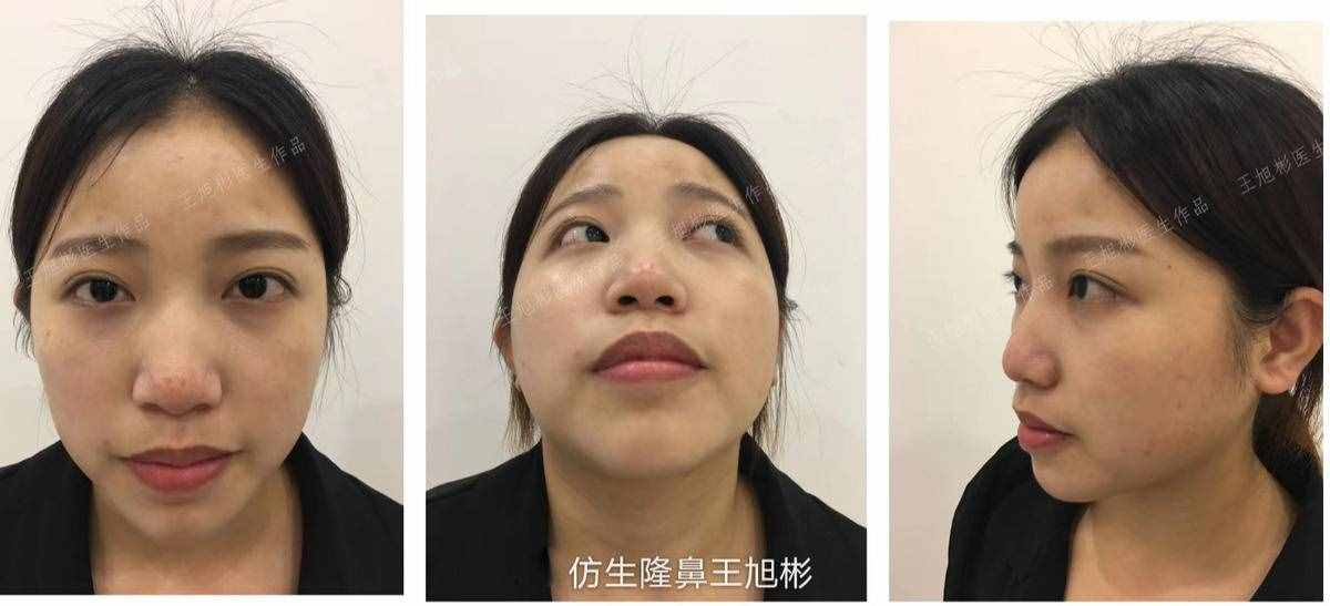 鼻頭肥塌大，如何逆襲成自然小秀挺？王旭彬仿生鼻尖整形案例