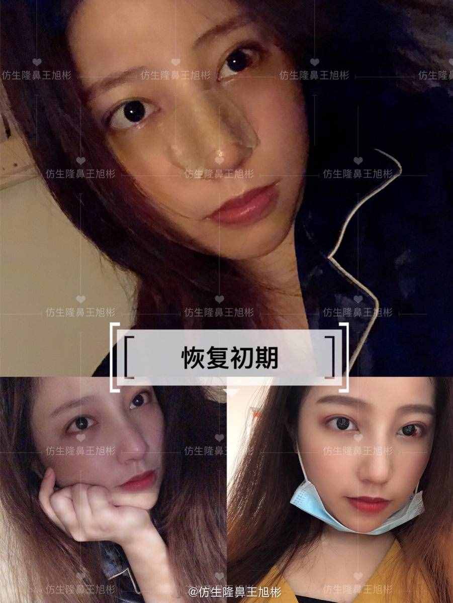 鼻頭肥塌大，如何逆襲成自然小秀挺？王旭彬仿生鼻尖整形案例