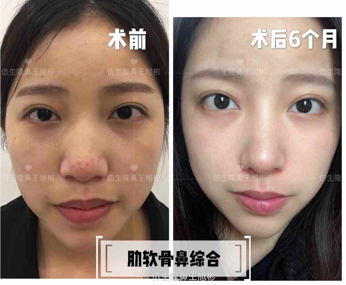 鼻頭肥塌大，如何逆襲成自然小秀挺？王旭彬仿生鼻尖整形案例