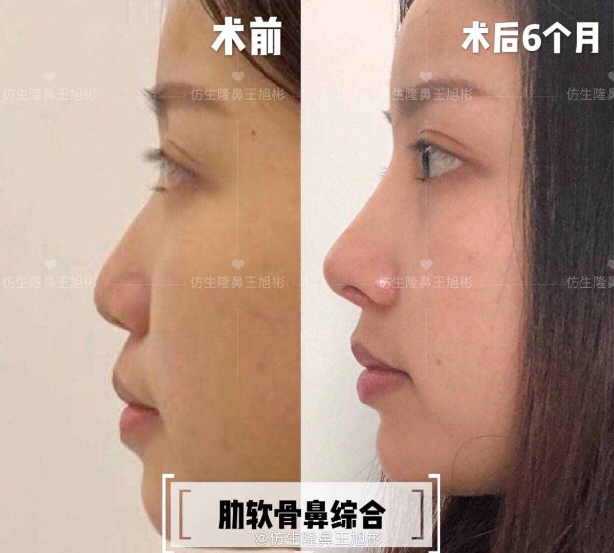 鼻頭肥塌大，如何逆襲成自然小秀挺？王旭彬仿生鼻尖整形案例