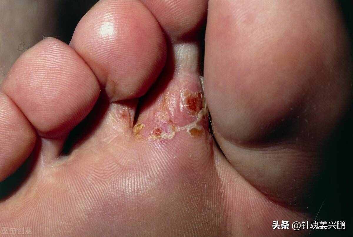 “腳氣”真菌怎么才能根治？3個(gè)人人實(shí)用的方法，徹底治好不復(fù)發(fā)