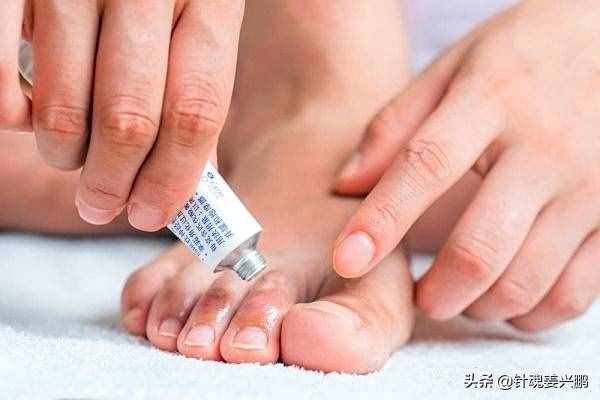 “腳氣”真菌怎么才能根治？3個(gè)人人實(shí)用的方法，徹底治好不復(fù)發(fā)