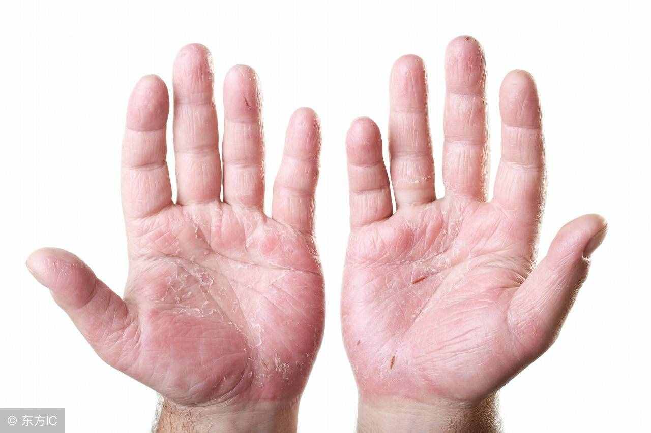 濕疹最典型的癥狀特點(diǎn)與分類