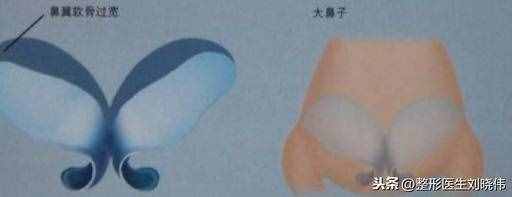 有什么好辦法能讓大鼻頭變??？