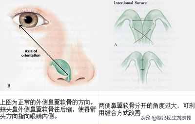 有什么好辦法能讓大鼻頭變??？