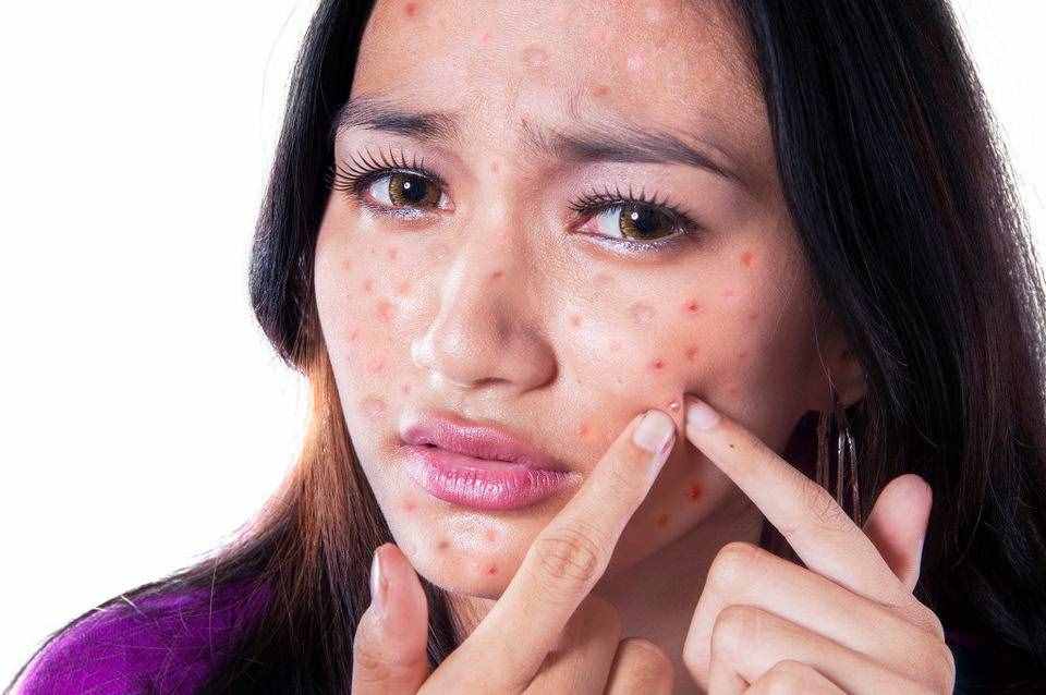 醫(yī)生治痤瘡常用3種方式，日常做好這2件事，也能拯救你的"痤瘡臉"