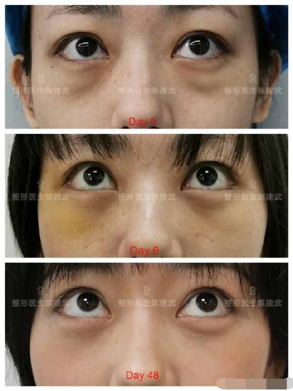 31歲美女內(nèi)切眼袋失敗，我?guī)退迯?fù)改善，重啟美麗人生