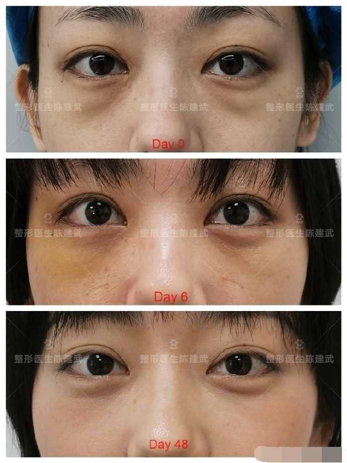 31歲美女內(nèi)切眼袋失敗，我?guī)退迯?fù)改善，重啟美麗人生