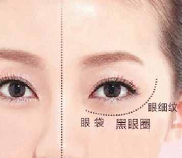 31歲美女內(nèi)切眼袋失敗，我?guī)退迯?fù)改善，重啟美麗人生