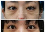 今日更新去眼袋失敗修復（31歲美女內(nèi)切眼袋失?。? /></span></a>
                        <h2><a href=