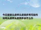 今日更新頭皮癢頭皮屑多有可能傳染嗎頭皮癢頭皮屑多該怎么辦