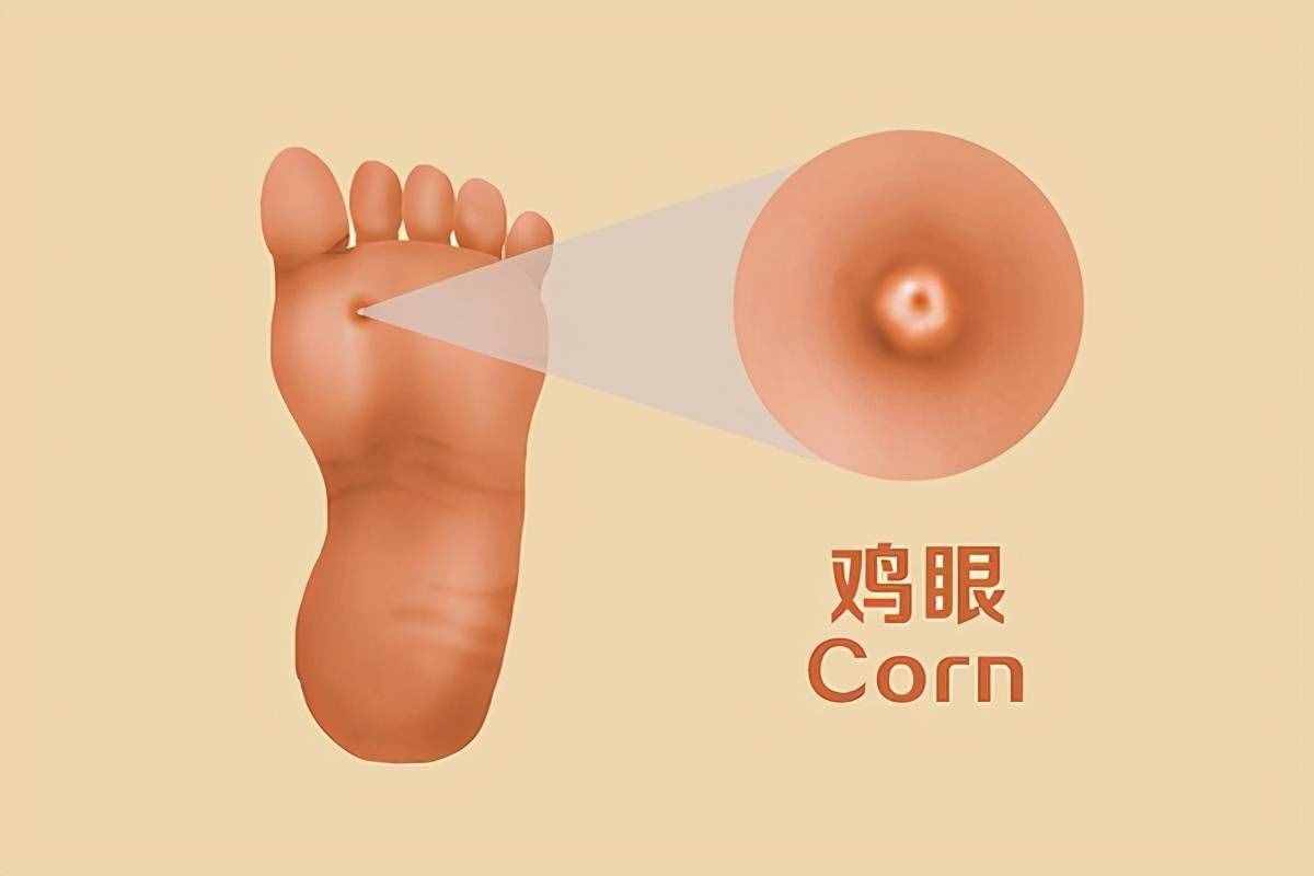 腳上長了雞眼，有什么好方法能去除？雞眼的原因有哪些？