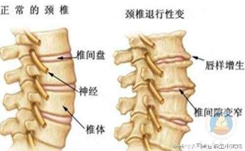 骨質(zhì)增生秘方大公開，告別疼痛，治一個好一個的良方！