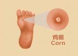 今日更新腳底長雞眼圖片（腳上長了雞眼）