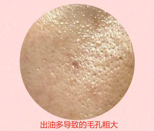 女人毛孔粗大怎么辦？掌握這些方法，原來(lái)收縮毛孔這么簡(jiǎn)單