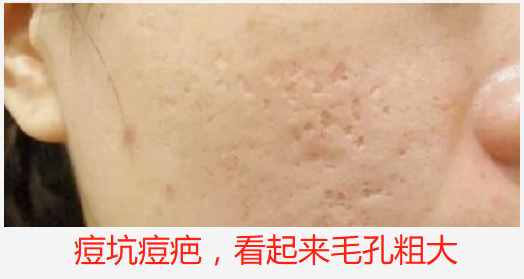女人毛孔粗大怎么辦？掌握這些方法，原來(lái)收縮毛孔這么簡(jiǎn)單