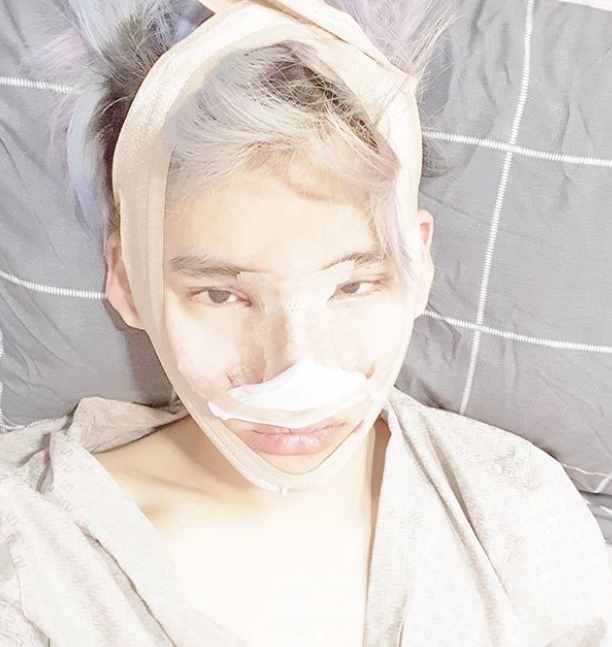 韓國男星曬整容前后對比，差距太大很驚人，被指最新照鼻尖像有坑